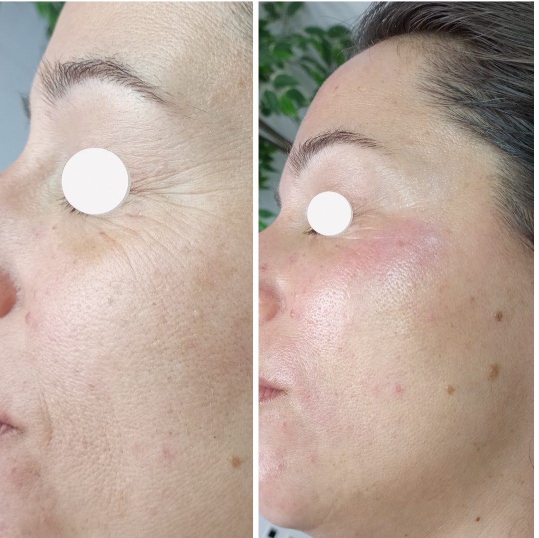 Limpieza facial Sabadell